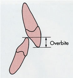Deep bite illustration